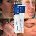 BataBata Whitening Freckles Cream Effective Remove Melasma Dark Spots Fade Pigmentation Moisturize Smooth Brighten Face Skin Care Product. 