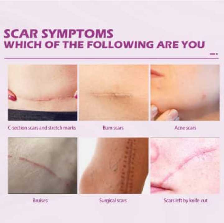 Scar Removal Cream Repairing Damaged Skin Reducing Scars And Smoothing The Skin 50g, কাটা ও পুড়ে যাওয়ার দাগ স্কিন থেকে মুছে ফেলুন। মুখমন্ডল, হাত, পা, বডি অথবা স্কিনের যেকোনো যায়গাতে ব্যবহার করতে পারবেন, #lazbinstore
