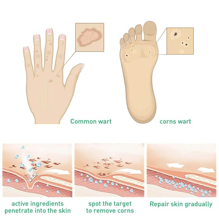 Corn%20Remover%20Strengthen%20Gel,Corn%20Remover%20Gel%20Extra%20Strength,Instant%20Blemish%20Removal%20Gel,Wart%20Remover%20Liquid,Corn%20Remover%20Liquid%20for%20Feet%20Toes%20Hands%20Care,Easy%20to%20Remove%20Calluses%20-%20Image%204