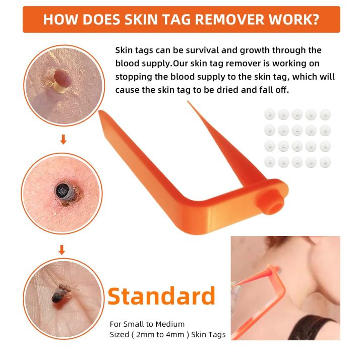 Painless%20Skin%20Tag%20Remove%20Device%20Kit%20Micro%20Tags%20Sized%20(2mm%20to%204mm)%20Warts%20Remover%20-%20Image%205