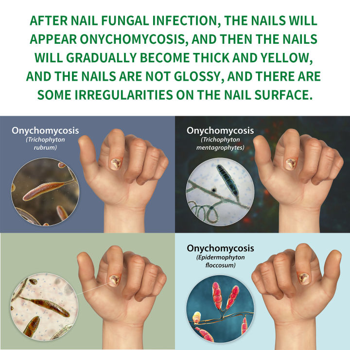 Jaysuing%20Ginger%20Nail%20Treatment%20Moisturizer%20for%20soft%20nails,%20nail%20brightening,%20nail%20fungus,%20nail%20repair,%20hand%20and%20foot%20nails%20-%20Image%202