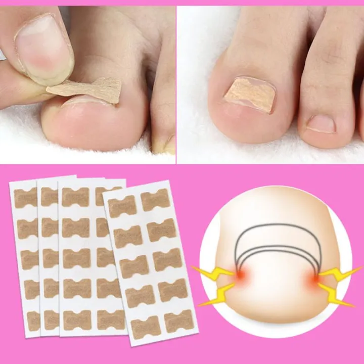 1/5pc%20Toe%20sticker%20Nail%20Strips%20Anti-roll%20Nail%20Glue%20Toe%20Inlay%20Nail%20Corrector%20Stickers%20Nail%20Patch%20Ingrown%20Toenail%20Correction%20Tool%20-%20Image%205