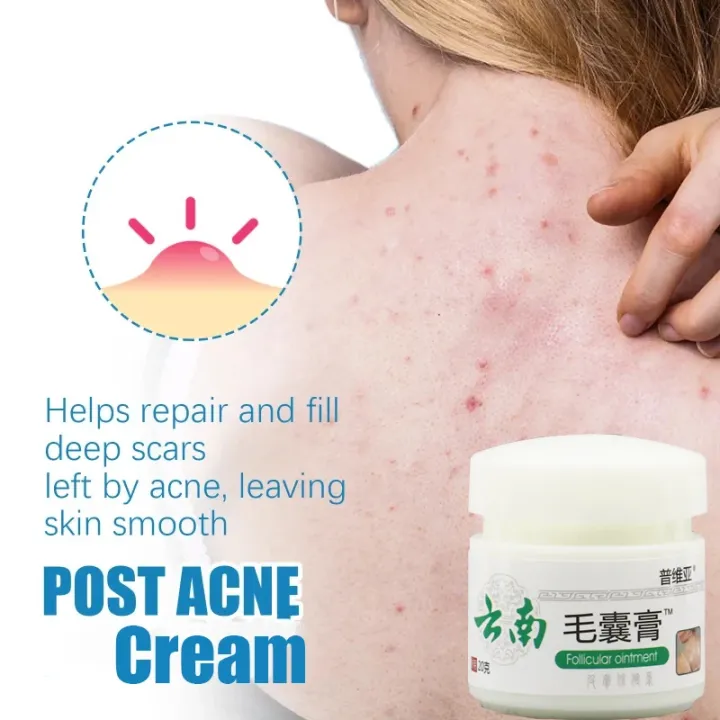 White%20Cream,%20Moisturizing%20Skin,%20Chicken%20Repair%20Cream,%20Buttocks,%20Back%20Acne,%20Body%20Acne%20Cream,%20Facial%20Sores,%20Smooth%20Marks%20-%20Image%206