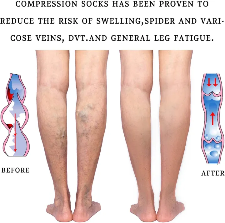 20-30%20mmHg%20Medical%20Compression%20Socks%20for%20Women%20and%20Men%20Knee%20High%20Open%20Toe%20Stockings%20Varicose%20Vein%20Swollen%20legs%20-%20Image%204