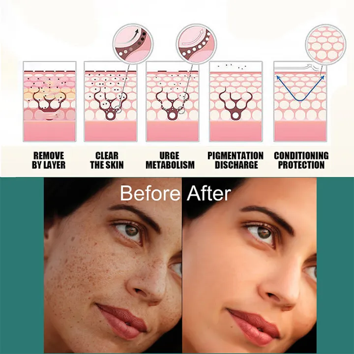 Melasma%20Removal%20Cream%20Niacinamide%20Brightening%20Reduce%20Melanin%20Facial%20Cream%20Lighten%20Dark%20Skin%20Shrink%20Pores%20Moisturizer%20Skin%20Care%20-%20Image%202