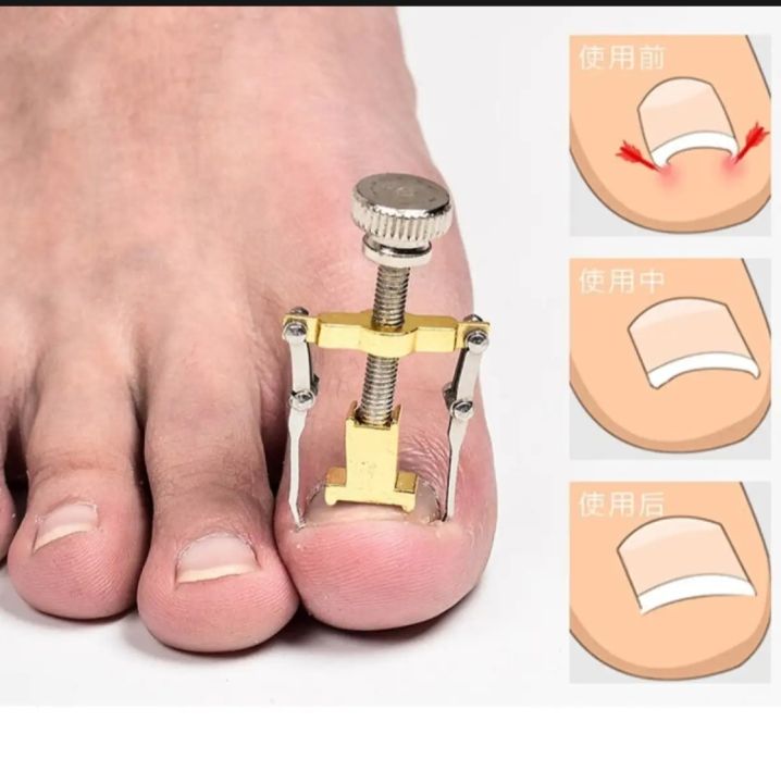 Professional Ingrown Toe Nail Recover Correction Fixer Manicure Pedicure Nails Care Tool