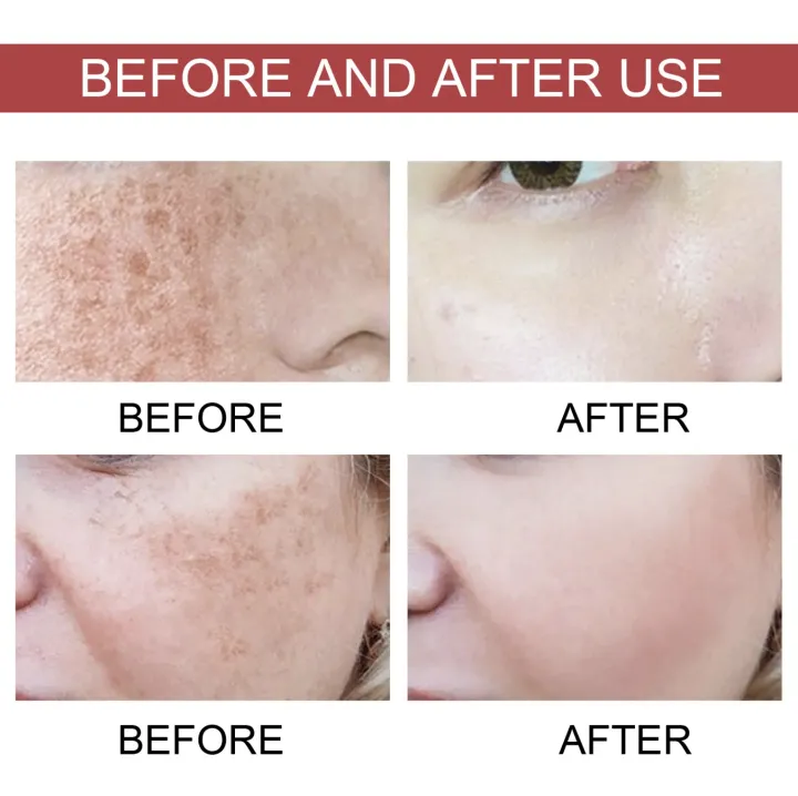 Hoygi%20Dark%20Spots%20Correcting%20Serum%20Niacinamide%2010%25%20+%20TXA%204%25%20+%20Arbutin,%20Reduces%20Dark%20Spots,%20Whitens%20&%20Brightens%20Skin%20-%20Image%204