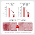 SADOER Fruit Acid AHA+BHA Acne Repair Serum- 30ml.