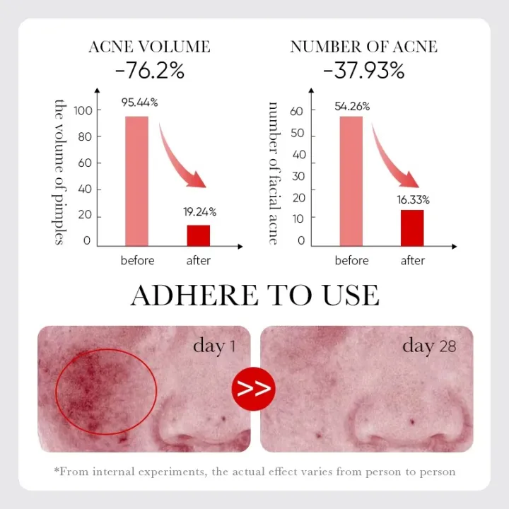 SADOER%20Fruit%20Acid%20AHA+BHA%20Acne%20Repair%20Serum-%2030ml%20-%20Image%206