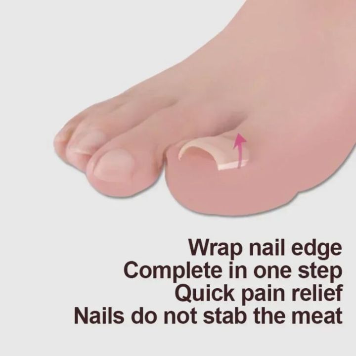 10pcs%20Ingrown%20Toenail%20Correction%20Tool%20Ingrown%20Toe%20Nail%20Treatment%20Elastic%20Patch%20Sticker%20Straightening%20Clip%20Brace%20Pedicure%20Tool%20-%20Image%202