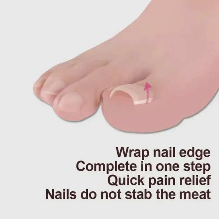 10pcs%20Ingrown%20Toenail%20Correction%20Tool%20Ingrown%20Toe%20Nail%20Treatment%20Elastic%20Patch%20Sticker%20Straightening%20Clip%20Brace%20Pedicure%20Tool%20-%20Image%202