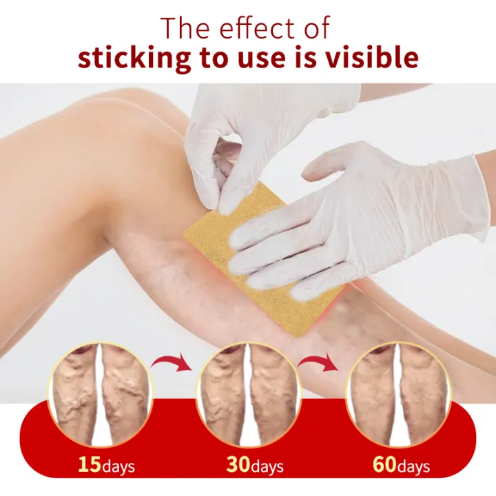 6Pcs%20Leg%20Patches%20For%20Varicose%20Veins%20Chinese%20Herbal%20Medicine%20Varicosity%20Angiitis%20Removal%20Phlebitis%20Spider%20Leg%20Veins%20Pain%20Plaster%20-%20Image%204