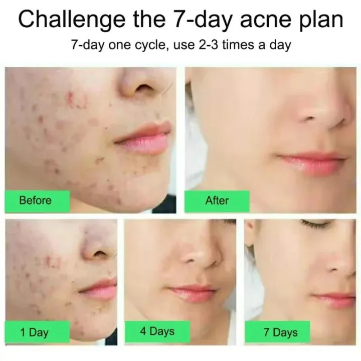 Salicylic%20Acid%20Acne%20Treatment%20Cream%20Repair%20Pimple%20Spots%20Deep%20Cleaning%20Pore%20Shrinking%20Anti-acne%20Oil%20Control%20Moisturizer%20Skin%20Care%20-%20Image%203