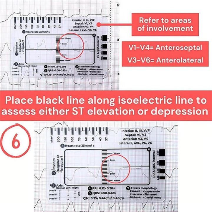 NCANRUI%202pc%20ECG%207%20Step%20Ruler,ECG%207%20Step%20Ruler%20for%20ECG/EKG%20Interpretation,%20ECG%20Reference%20Guide%20Ruler,EKG%20Calipers%20Measuring%20Tool%20-%20Image%204