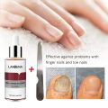 LANBENA Nail Repair Essence Serum Fungal Nail Treatment Remove Onychomycosis Toe Nourishing Brighten Hand Foot Skin Care 12ml.