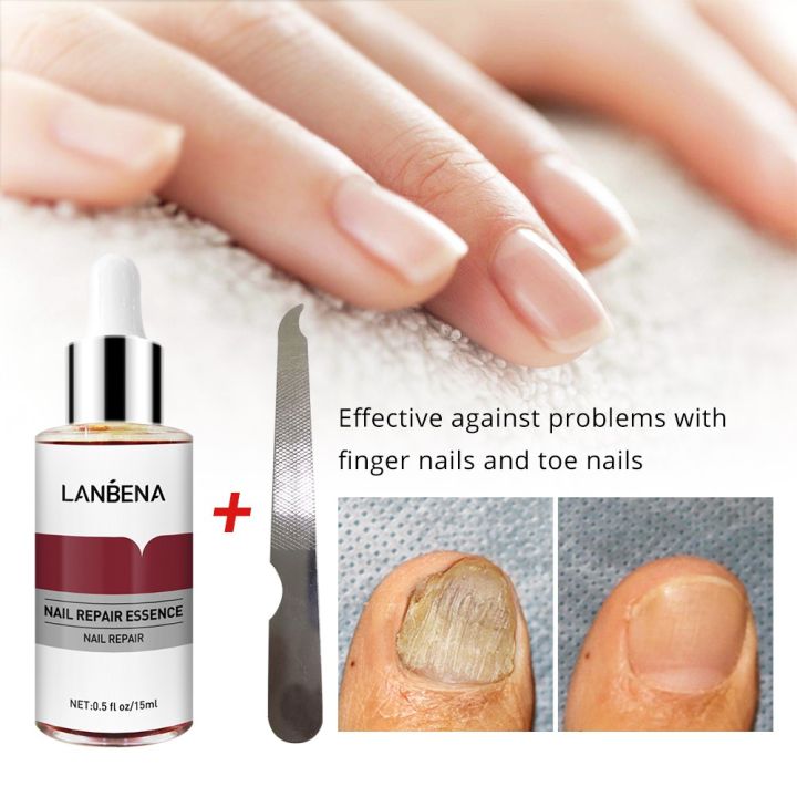 LANBENA%20Nail%20Repair%20Essence%20Serum%20Fungal%20Nail%20Treatment%20Remove%20Onychomycosis%20Toe%20Nourishing%20Brighten%20Hand%20Foot%20Skin%20Care%2012ml%20-%20Image%203
