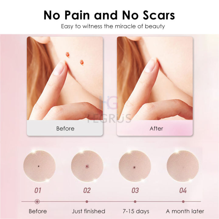 HEGRUS%20Face%20Mole%20Removal%20Pen%20Spots%20Tattoo%20Freckle%20Removal%20Pen%20LED%20Lighting%20Sweep%20Spot%20Mole%20Removing%20Dark%20Spot%20Remover%20Skin%20Care%209%20Adjustable%20Modes%20Laser%20Mole%20Pen%20-%20Image%203