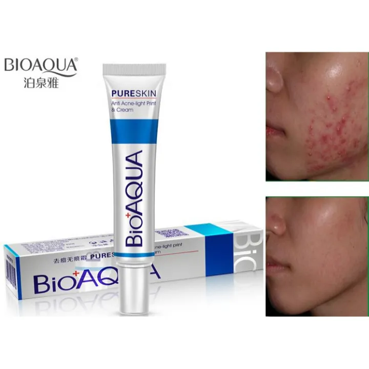 BIOAQUA%20Acne%20Scar%20Gel%20-%20Natural%20Blemish%20&%20Pimple%20Spot%20Removal%20Cream%20for%20Oil%20Control%20&%20Shrink%20Pores-30gm%20-%20Image%203