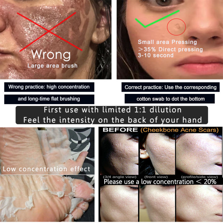 TCA%2020%25%2030%25%2035%25%2040%25%2050%25%2060%25%2070%25%20Pure%20TCA%20Peel%20Solution%20for%20Sun%20Damage%20Fine%20Lines%20Wrinkles%20Dull%20Skin%20Uneven%20Skin%20Tone%20Enlarged%20Po%20-%20Image%205