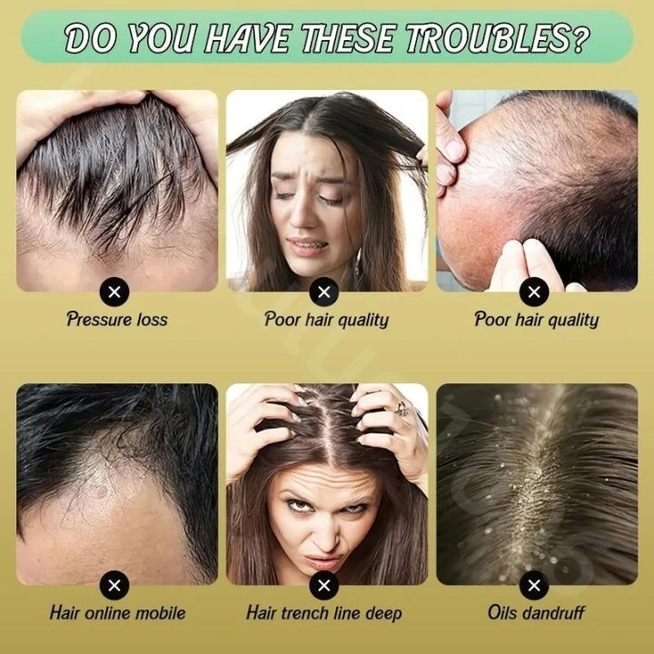 Ginger%20Plant%20Extract%20Anti-Hair%20Loss%20Hair%20Shampoo%20Ginger%20Extract%20From%20Japan%20Polygonum%20Multiflorum%20Oil%20Control%20Anti-Dandruff%20240ML%20-%20Image%205