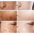 Effective Whitening Freckles Cream Remove Melasma Dark Spots Fade Pigmentation Moisturize Brighten Face Korean Skin Care Product. 
