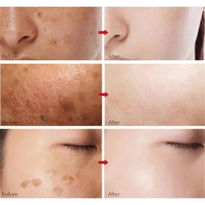 Effective%20Whitening%20Freckles%20Cream%20Remove%20Melasma%20Dark%20Spots%20Fade%20Pigmentation%20Moisturize%20Brighten%20Face%20Korean%20Skin%20Care%20Product%20-%20Image%204