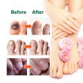 Nail Fungal Treatment Serum Anti Infection Toe Fungus Repair Liquid Cuticle Paronychia Onychomycosis Hand Foot Nail Care Essence. 