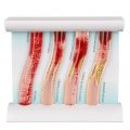 LDL Cholesterol Blood Vessel Model, 4-Stage Vascular Disease Teaching and Training Tool. 