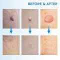 3 In 1 Auto Skin Tag Remover Painless Mole Wart Removal Kit Device Professional Verrugas Eliminar Face Care Beauty Tool Home Use. 