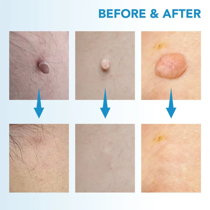 3%20In%201%20Auto%20Skin%20Tag%20Remover%20Painless%20Mole%20Wart%20Removal%20Kit%20Device%20Professional%20Verrugas%20Eliminar%20Face%20Care%20Beauty%20Tool%20Home%20Use%20-%20Image%205