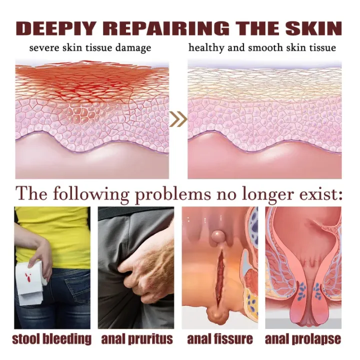 Hemorrhoid%20Relief%20Cream%20External%20Anal%20Fissure%20Therapy%20Internal%20Swell%20Bleed%20Treatment%20Anti%20Meatball%20Anal%20Itching%20Herbal%20Ointment%20-%20Image%204