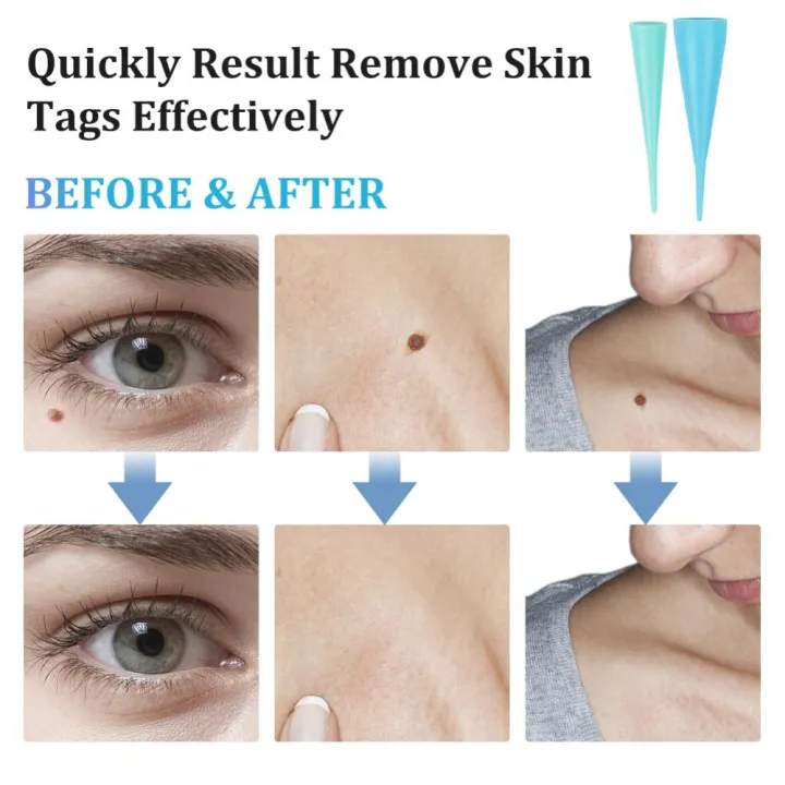 2-IN-1%20Auto%20Skin%20Tag%20Removal%20Kit%20Painless%20Skin%20Label%20Mole%20Acne%20Wart%20Removal%20Pen%20Set%20with%20Cleansing%20Swabs%20Facial%20Beauty%20Care%20Tool%20-%20Image%208