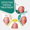 10PCS Ingrown Toenail Correction Tool Nail Treatment Toe Nail Sticker Foot Care Pedicure Foot Orthodontic Toe Thumb Nail Patches. 