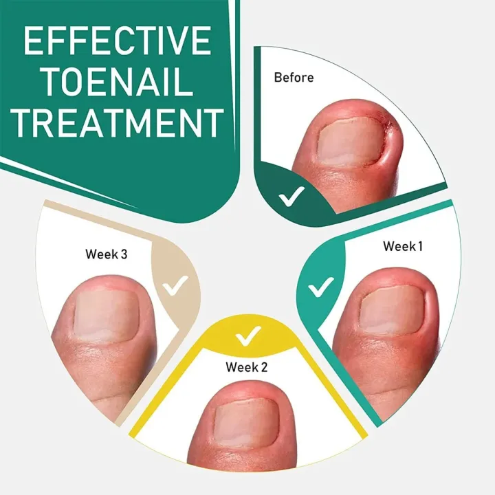 10PCS%20Ingrown%20Toenail%20Correction%20Tool%20Nail%20Treatment%20Toe%20Nail%20Sticker%20Foot%20Care%20Pedicure%20Foot%20Orthodontic%20Toe%20Thumb%20Nail%20Patches%20-%20Image%205