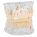Pathology Model With Missing Tooth Tooth-tooth For Dental Experimental. 