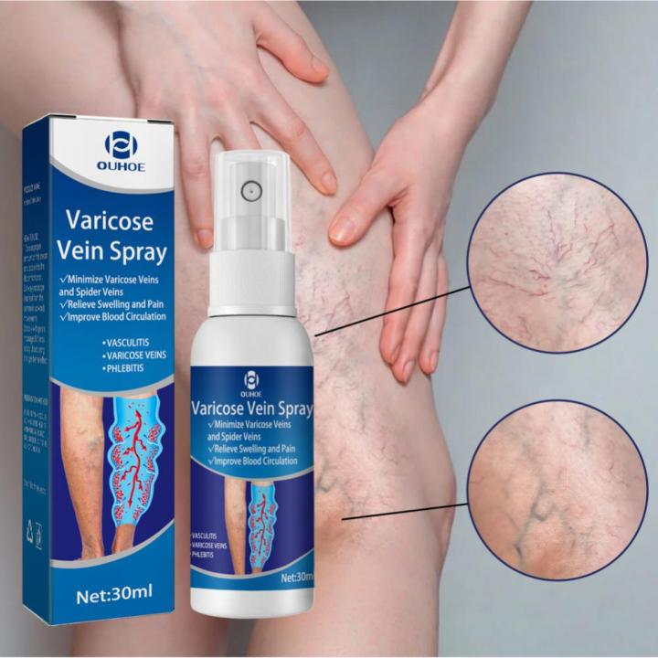 Varicose%20Veins%20Spray%20Medicine%20Spider%20Veins%20Relief%20Vasculitis%20Phlebitis%20Spider%20Pain%20Relief%20Plaster%20Care%2030ml%20-%20Image%202