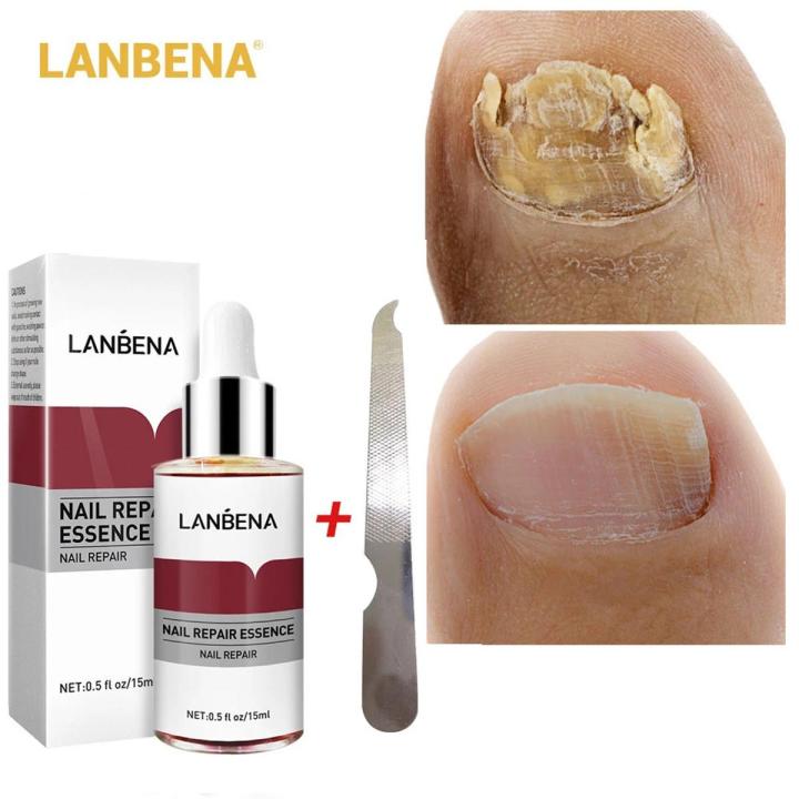 LANBENA Nail Repair Essence Serum Fungal Nail Treatment 12ml