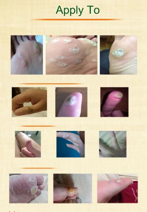 6%20pcs%20Medical%20Plasters%20Foot%20Corn%20Removal%20Curative%20Patches%20Calluses%20Callosity%20Detox%20Foot%20Pads%20Toe%20Patches%20-%20Image%208