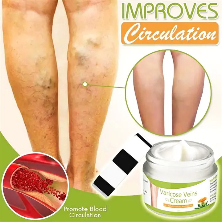 Varicose%20Veins%20Cream%20-%20Image%203