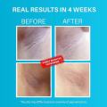 Dermdoc Underarm Treatment Spray, 5% Glycolic Acid -100 ml. 