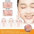Hydrocolloid Acne Face Mask - 5 Large Pimple Patches For Zit Breakouts On Nose, Chin, Forehead And Cheeks 10pcs/box R7L7. 