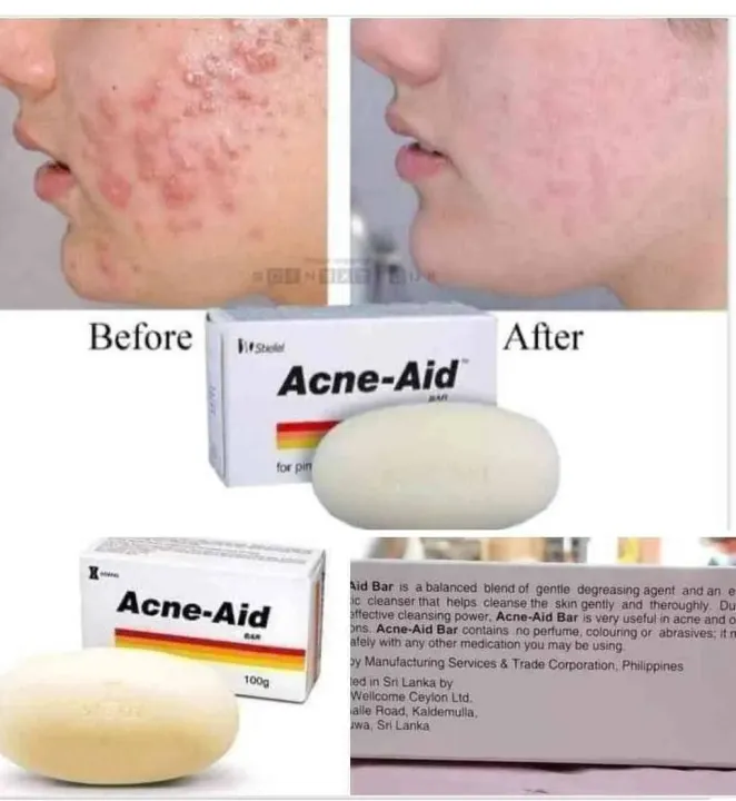 Stiefel Acne-Aid Bar 100g Pimple Prone & Oily Skin Acne Aid Soap ...