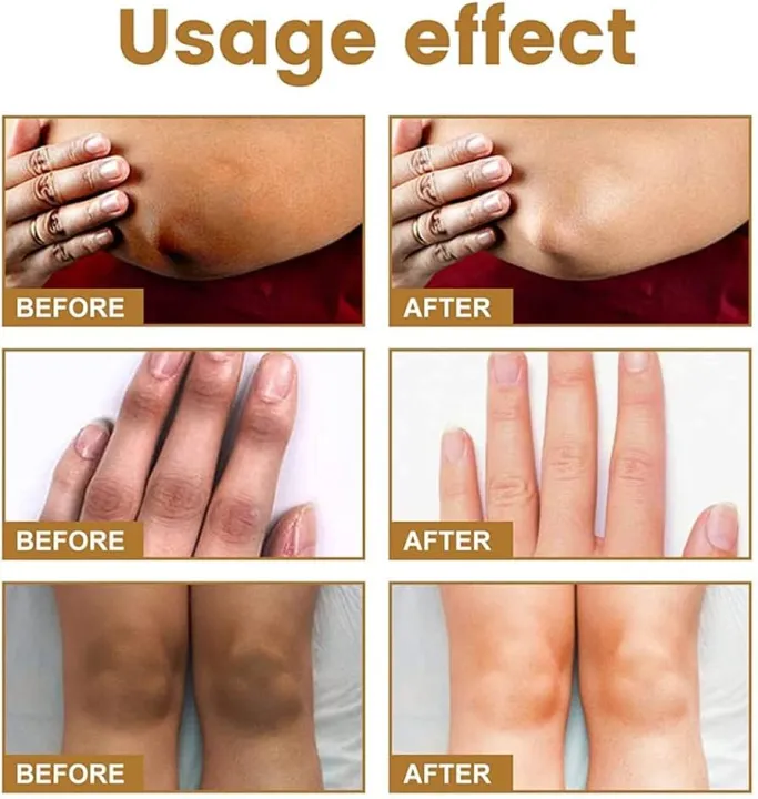 JAYSUING%20Private%20Label%20Therapy%20Drops%20Serum%20Knee%20Elbow%20Finger%20Joint%20Brightening%20Darkening%20Treatment%20Skin%20Care%20Serum-10ml%20-%20Image%203