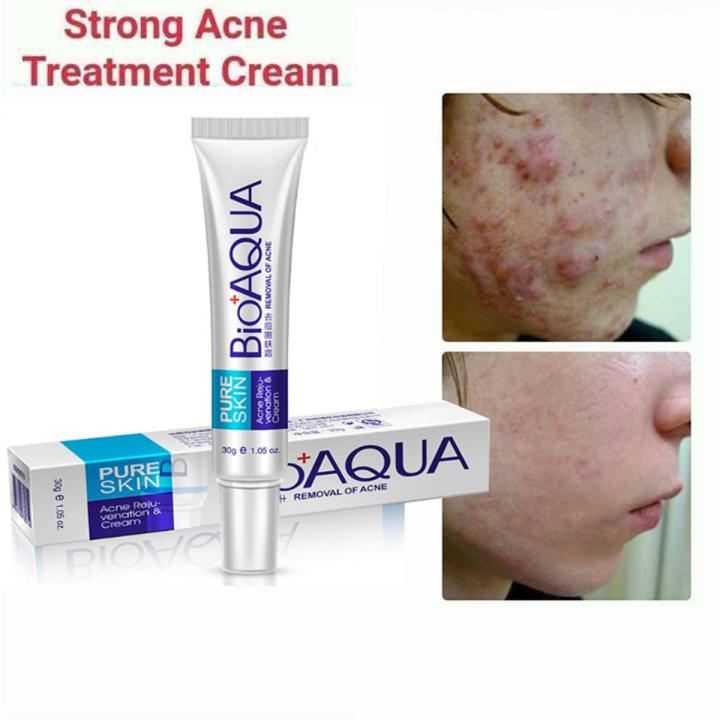 Face S-kin Care Acne Anti-Wrinkle Removal Cream Spots Scar Blemish ...