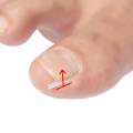 10Pieces Ingrown Toenail Corrector Strips Toenail Correction Tool Men. 