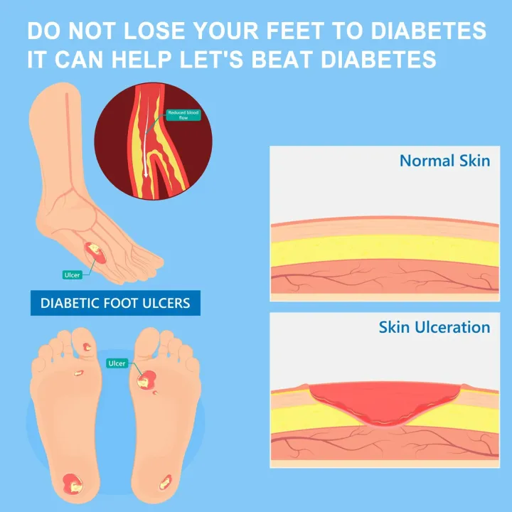 Diabetes%20Treatment%20Foot%20Cream%20Repair%20Feet%20Ulceration%20Relieve%20Itchy%20Improve%20Heel%20Cracking%20Nourishing%20Blood%20Sugar%20Care%20Ointment%20-%20Image%204