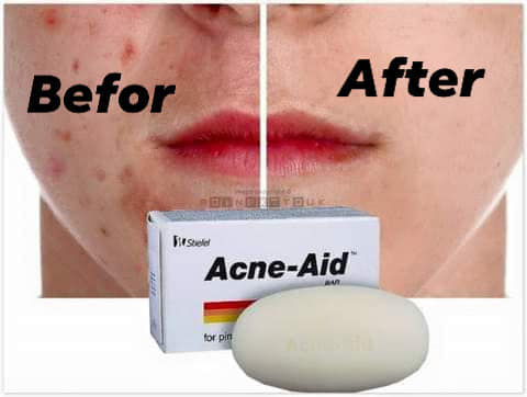 Stiefel Original Acne-Aid Bar 100g Pimple Prone & Oily Skin Acne Aid Soap by Lux