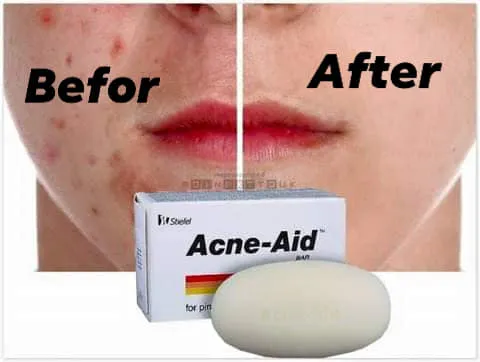 Stiefel Original Acne-Aid Bar 100g Pimple Prone & Oily Skin Acne Aid ...