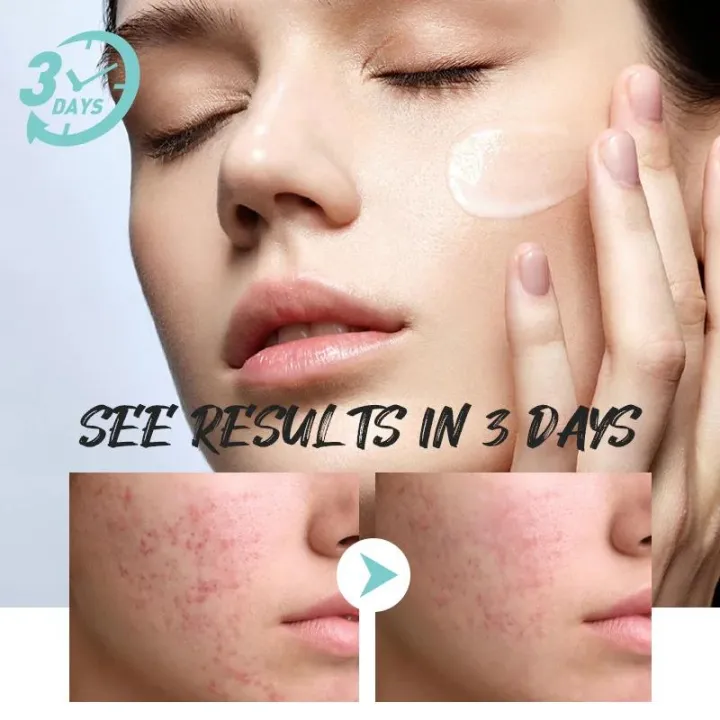 Effective%20Facial%20Redness%20Repair%20Cream%20Rosacea%20Treat%20Sensitive%20Skin%20Dryness%20Moisturizer%20Hydrating%20Sooth%20Lotion%20Korean%20Cosmetics%20-%20Image%203