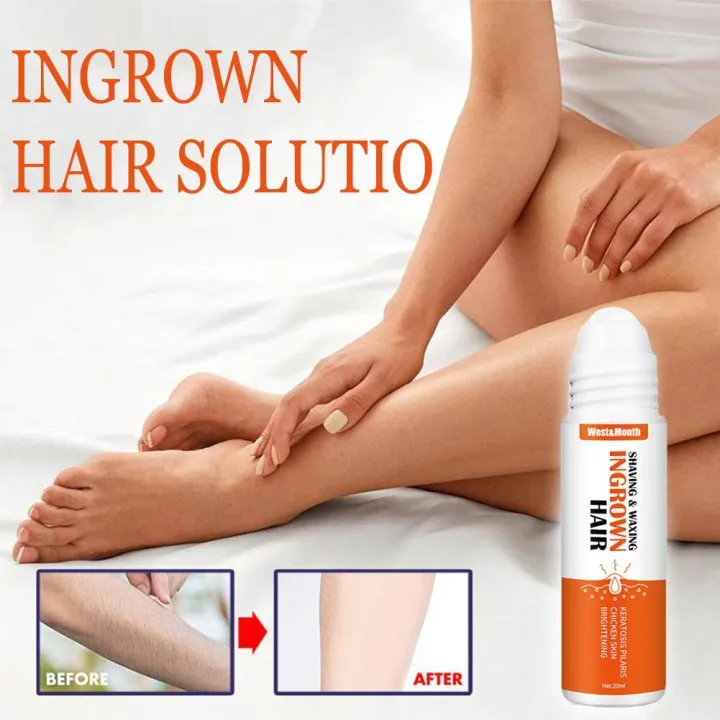Ingrown%20hair%20after%20shaving%20treatment%20for%20dark%20spots%20repair%20serum%20M2Z1%20-%20Image%203